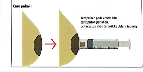 Cara Membuat dan Memakai Alat Penarik Puting dari Spuit